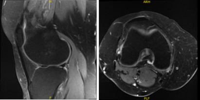 MRI-3T Knee non-contrast