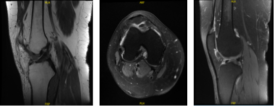 MRI-3T Right knee non-contrast