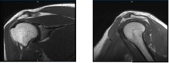 MRI-3T Right shoulder non-contrast