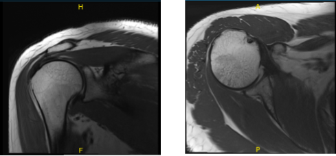 MRI-3T Hombro derecho sin contraste