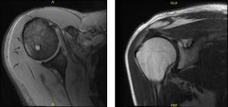 MRI Right shoulder non-contrast