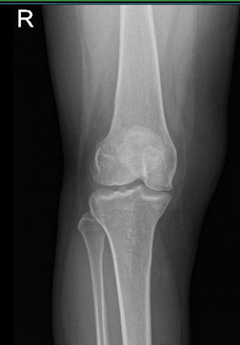 Resonancia magnética de la rodilla derecha