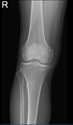 MRI of right knee