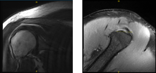 MRI of right shoulder