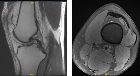 MRI of the back spine