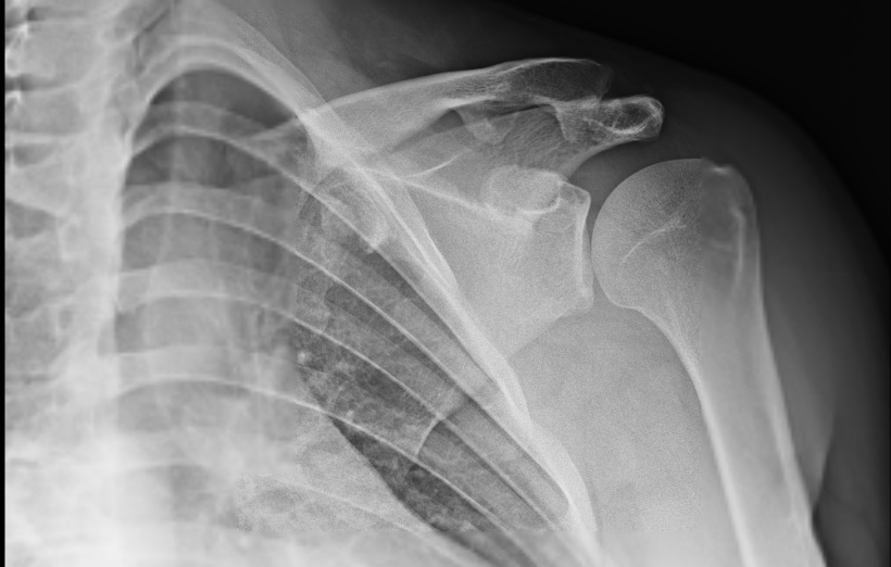 MRI of the shoulder