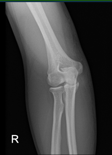 Postoperative X-ray of right elbow