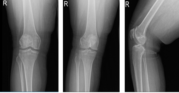 Right knee X-ray AP Lateral and Oblique 3 views