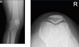 Right knee X-ray