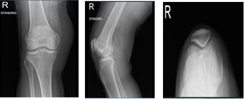 Right knee x-ray complete with patella