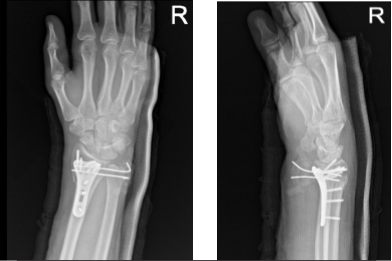 Right wrist X-ray 3 or more views-1st week post operative