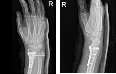 Right wrist X-ray 3 or more views-2nd week post operative