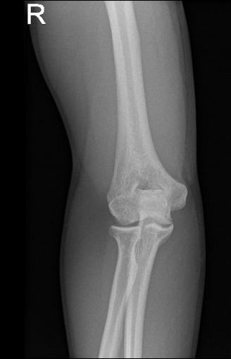 X-ray of right elbow