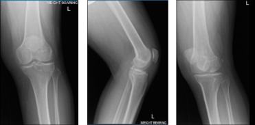 MRI of Left knee