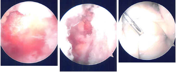 Intraoperative Arthroscopic Images