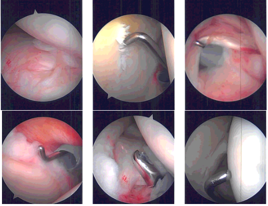 Intraoperative Arthroscopy Images