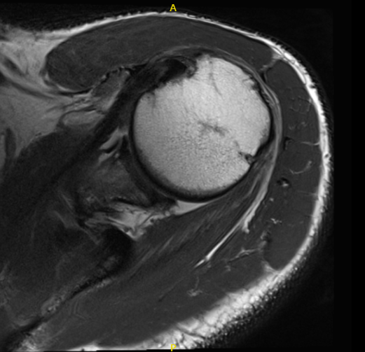 MRI of left shoulder