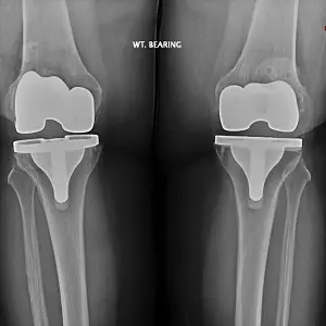 joint-replacement-xray